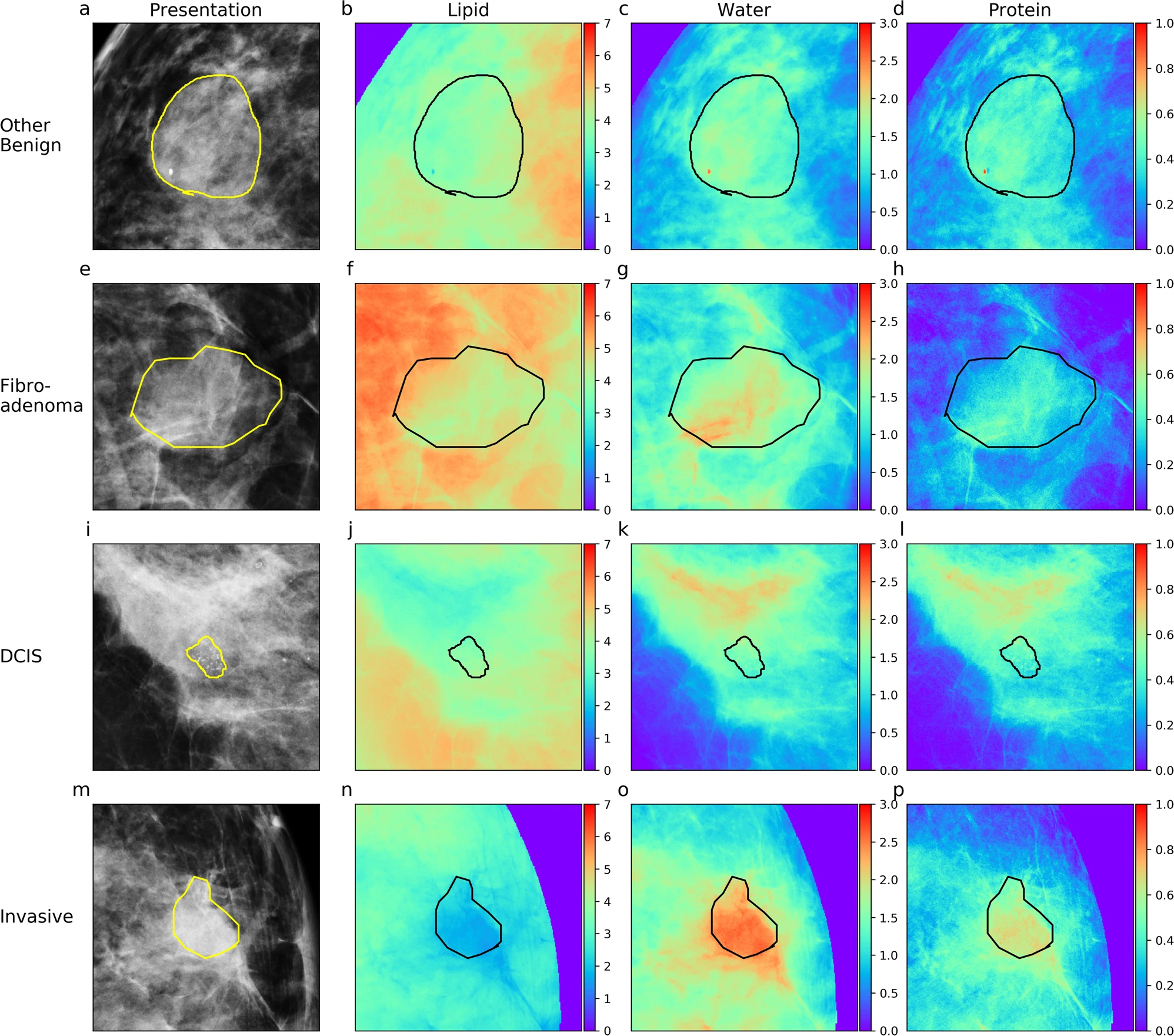 Deep Learning Improves Prediction and Detection of Malignant Breast Cancer