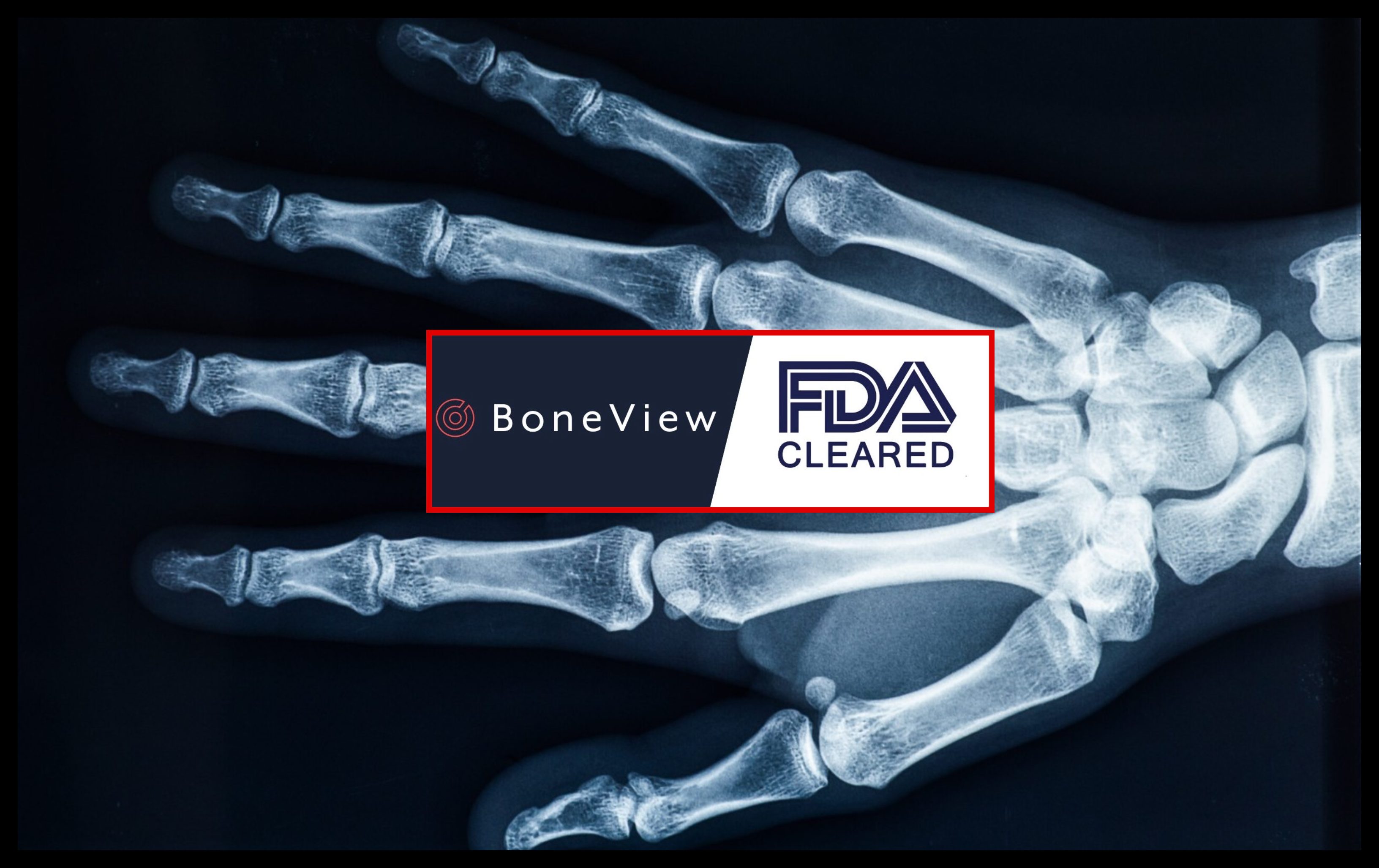 FDA Approves AI That Helps Hospitals Reduce Missed Fractures By 29%